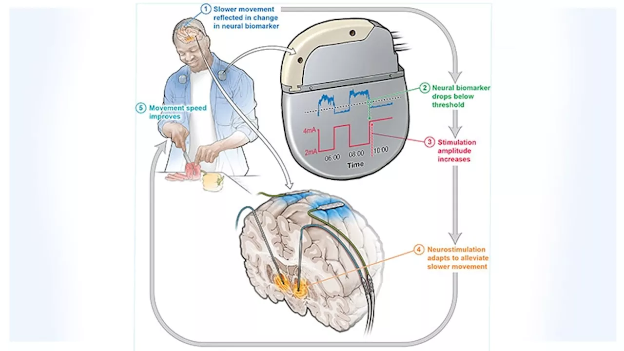 Adaptive Brain Stimulation a 'Game Changer' for Parkinson's?