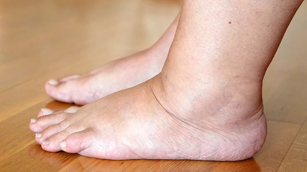 Which Medications Can Cause Edema?