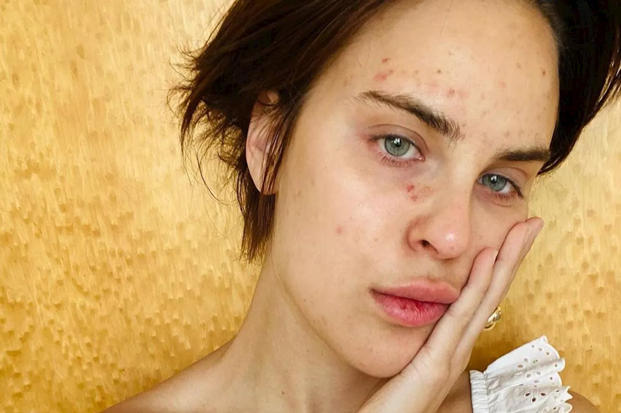 Tallulah Willis Shares Photo of Her Face amid Skin Picking: ‘Picking Happens, It Can Be Beautiful’