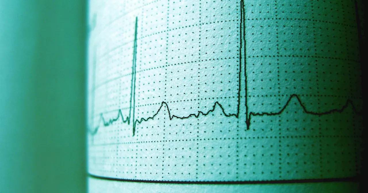 New study reveals link between white-collar work and atrial fibrillation.