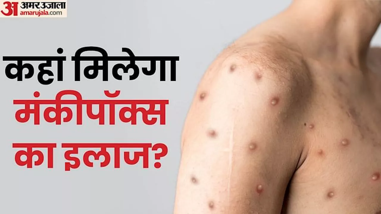 Mpox: जान लीजिए दिल्ली के किन अस्पतालों में मिलेगा मंकीपॉक्स का इलाज, लक्षण और बचाव भी जानें