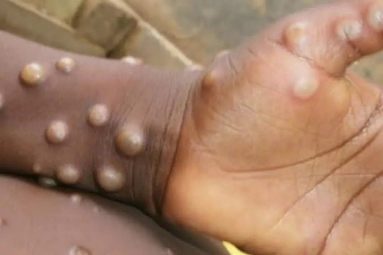 WHO says mpox not new COVID as Rivers confirms two cases