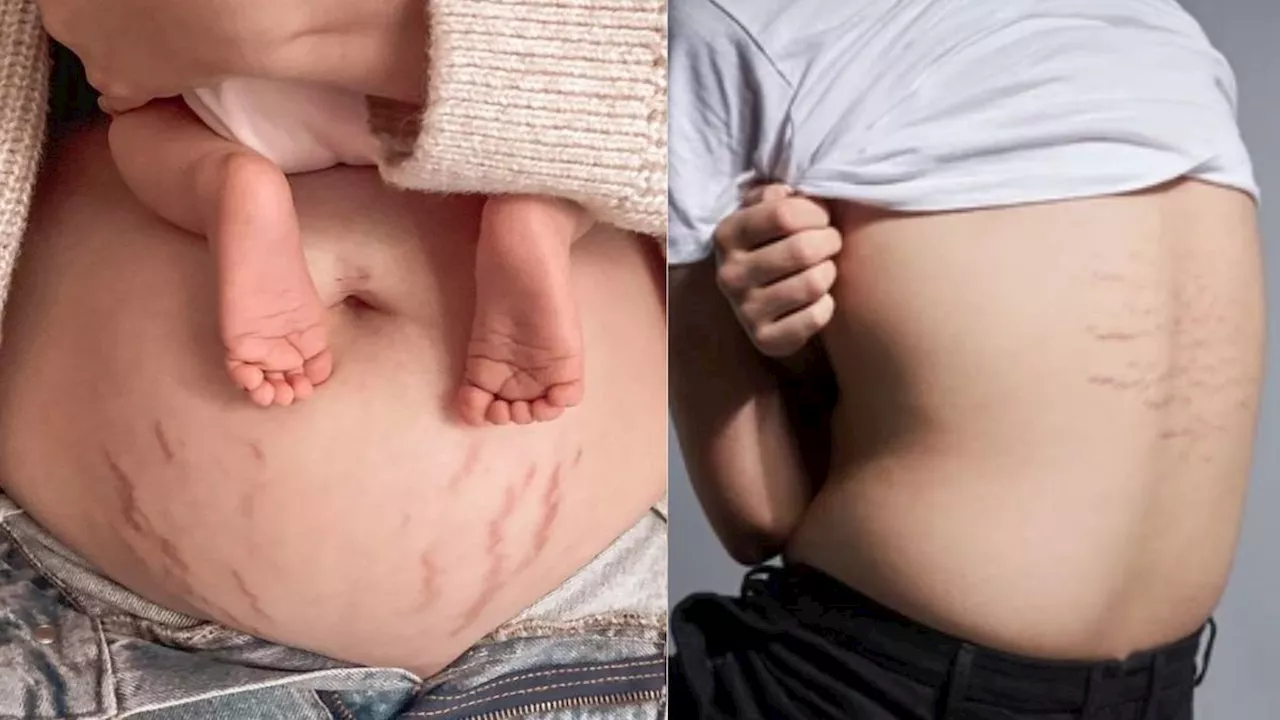 बिना ₹1 खर्च किए 7 दिनों में गायब होंगे stretch marks, एलोवेरा जेल में मिलाकर लगाएं ये चीजें