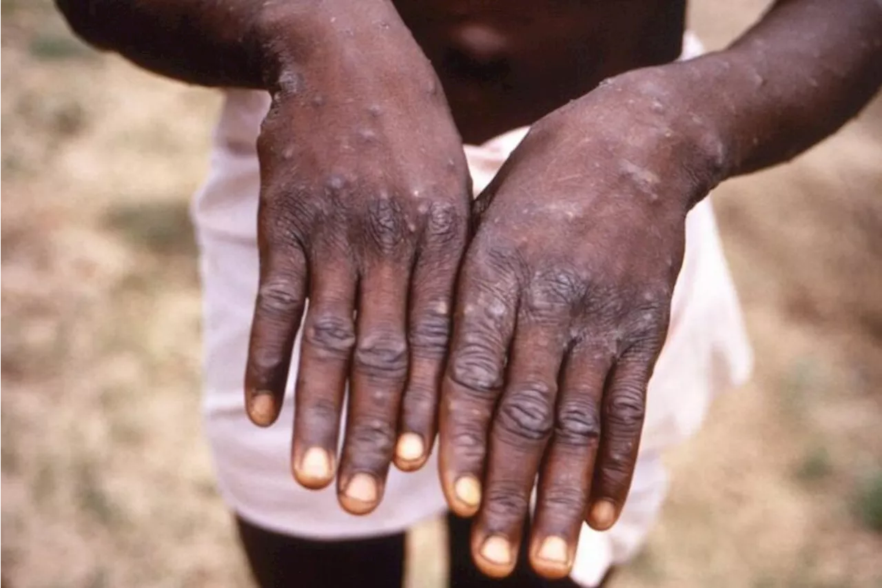 Edo records three suspected cases of Mpox