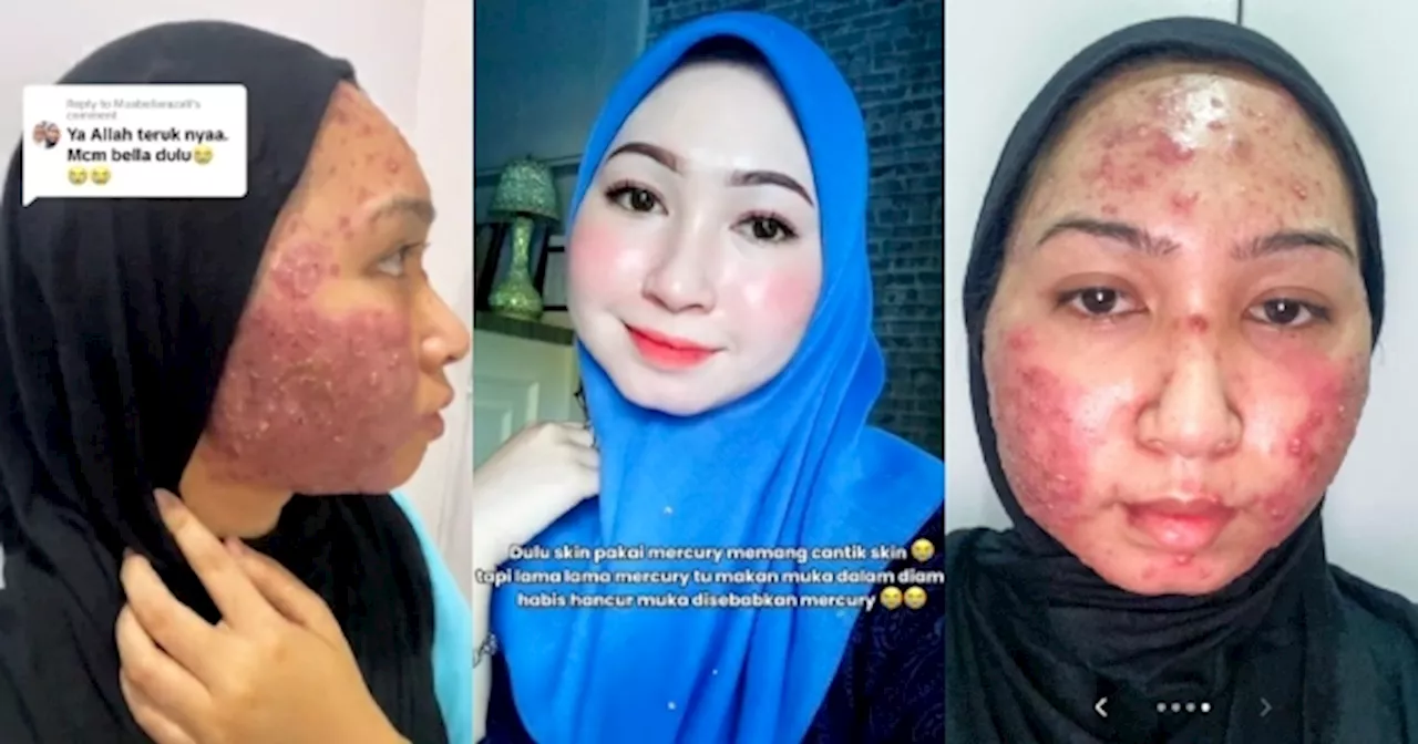 Jadi Mangsa Produk Kosmetik Merkuri, Wanita Kongsi Derita Kulit Breakout Pada Usia Muda