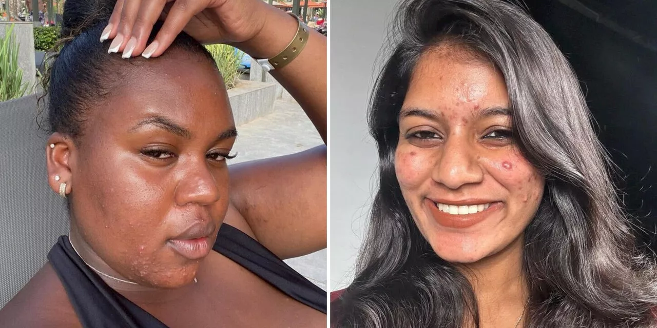 Just 12 People Proudly Sharing Unfiltered, Makeup-Free Pics of Their Acne