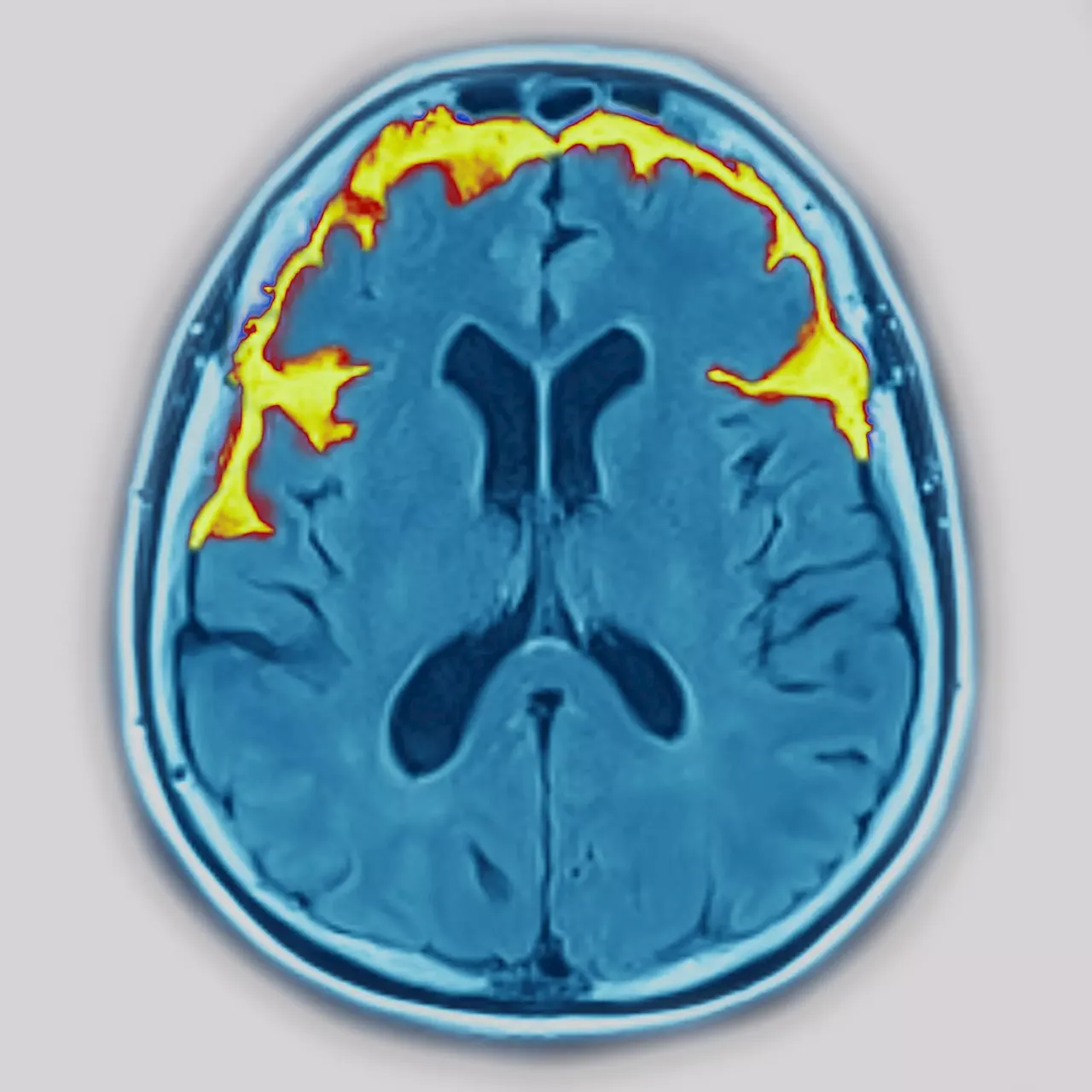 O medicamento para a doença de Alzheimer Lecanemab retarda o declínio cognitivo e recebe luz verde no Reino Unido