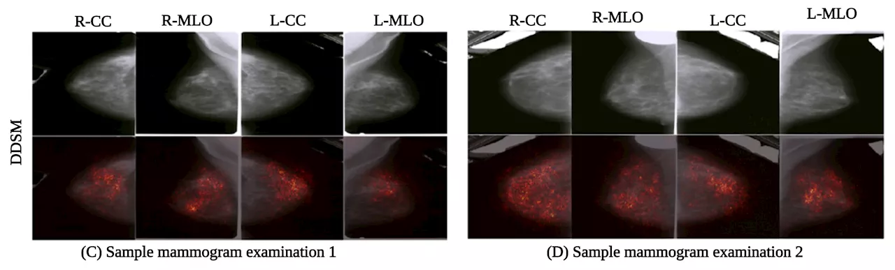 Novel AI algorithm assists in breast cancer screening