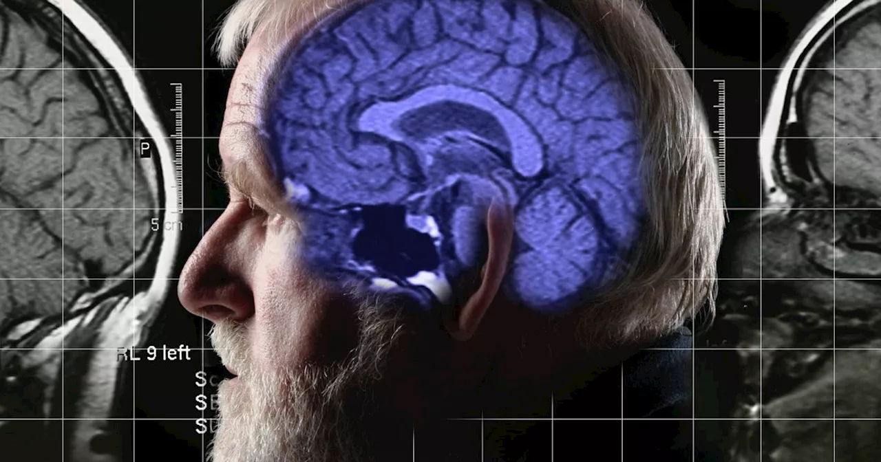 Alzheimer's lecanemab drug may NOT be available on NHS as 'not cost effective'