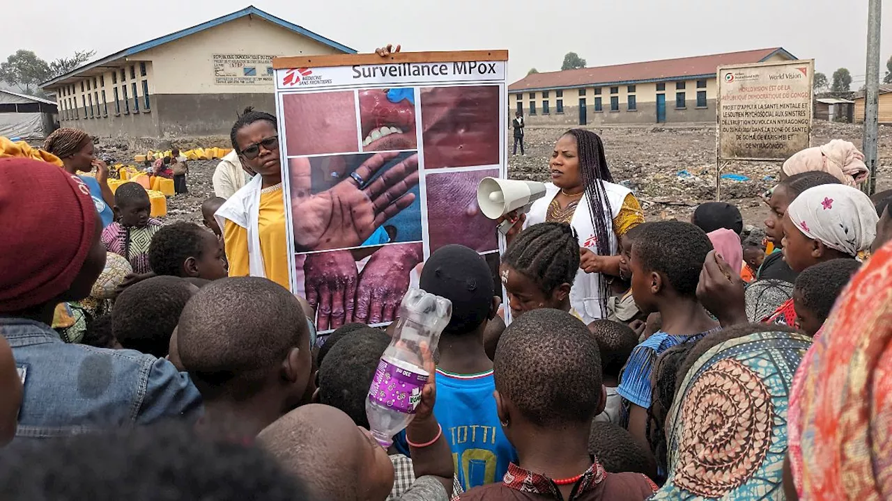 Zahl der Krankheitsfälle steigt: UNICEF: Kinder besonders gefährdet durch neue Mpox-Variante