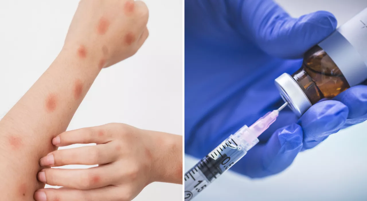 Vaiolo delle scimmie (Mpox), efficacia e reazioni avverse al vaccino: cosa c'è da sapere