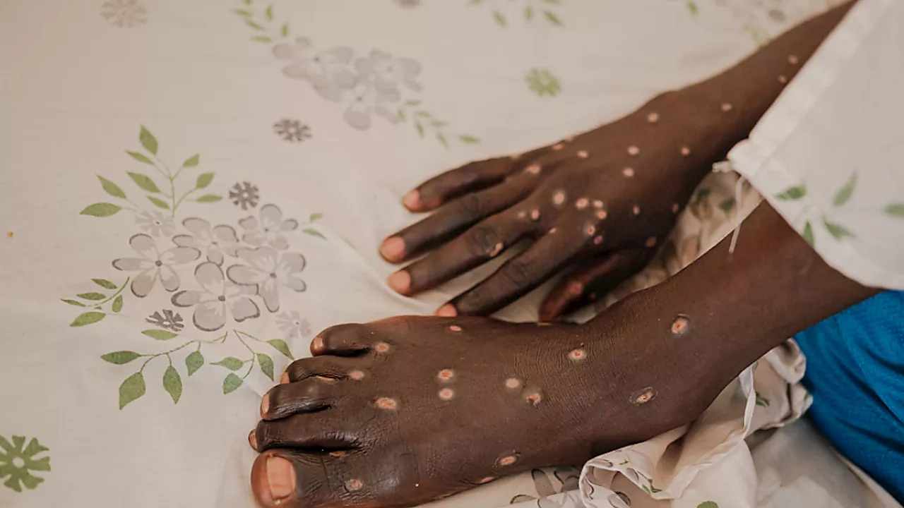 Österreich spendet Mpox-Impfstoff an afrikanische Staaten