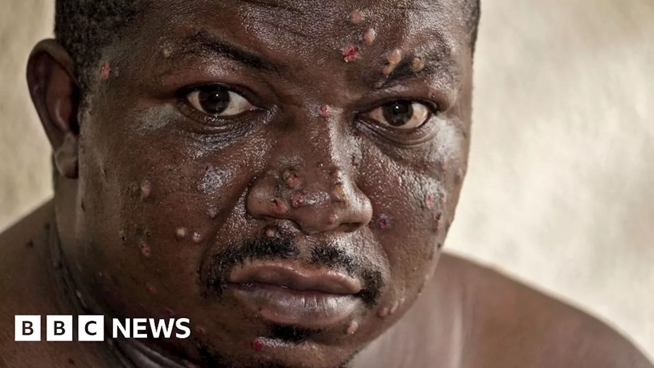 Mpox in Burundi: On the frontline of the fight to halt the spread