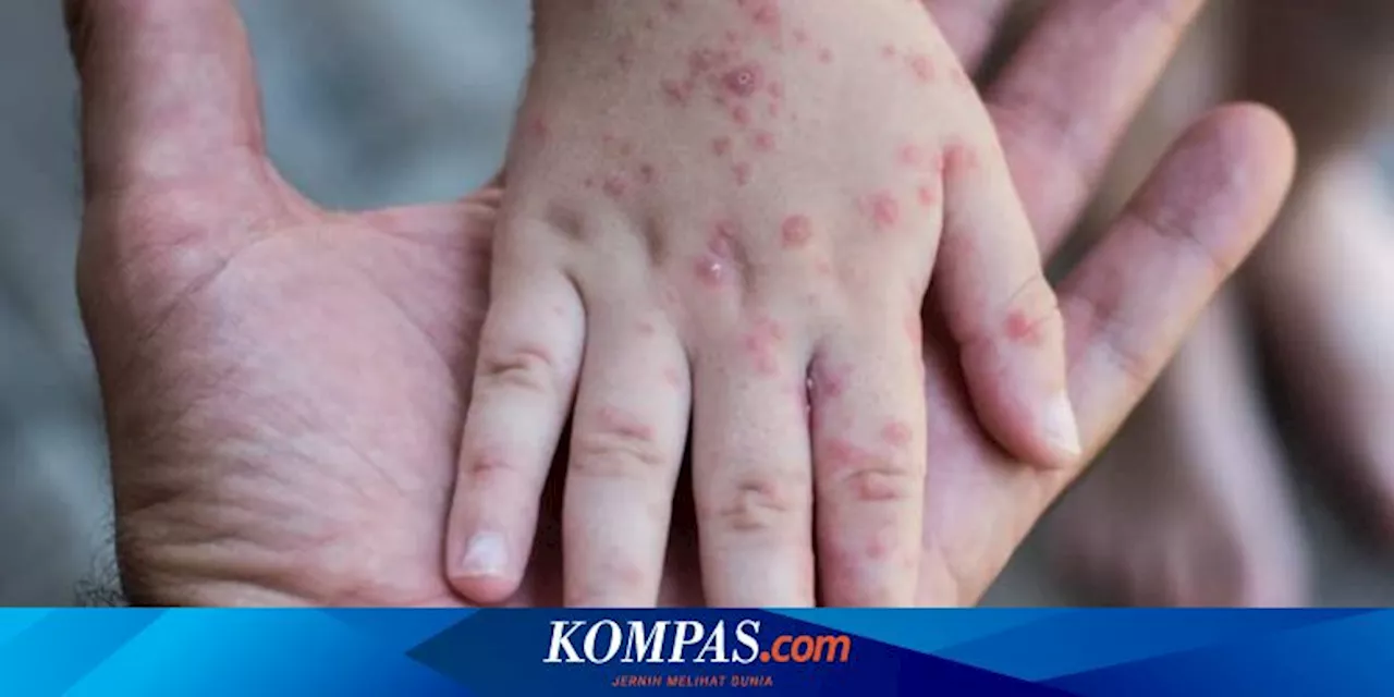 Dosen UGM Sebutkan Ciri-ciri Gejala Monkeypox atau Cacar Monyet