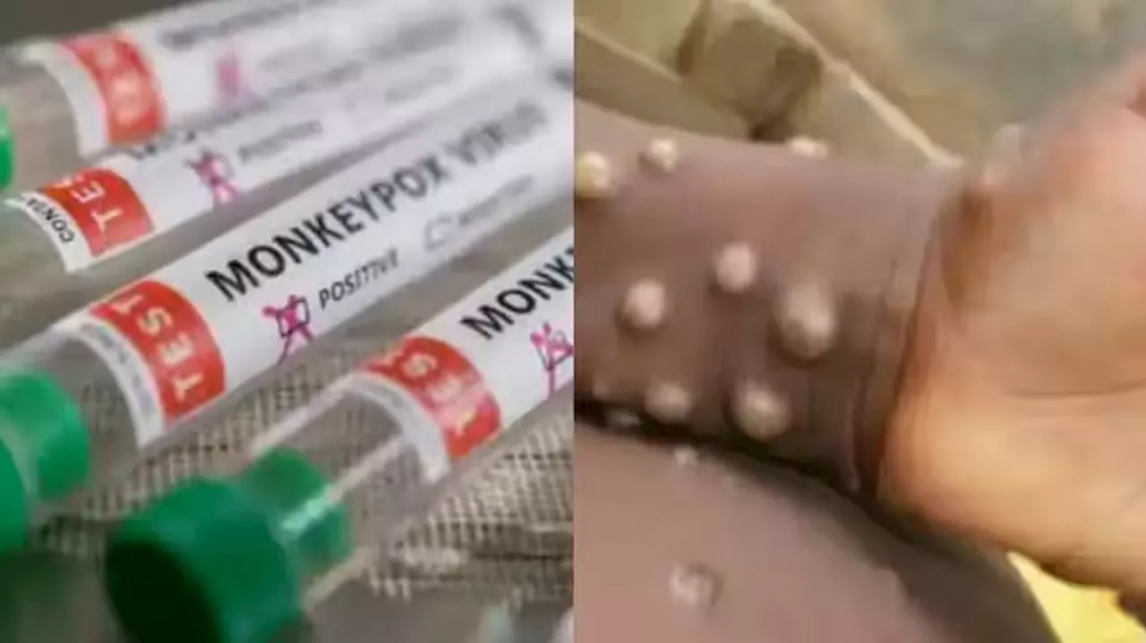 Monkeypox: ಮಂಕಿಪಾಕ್ಸ್ ವೈರಸ್‌ ಹೇಗೆ ಹರಡುತ್ತದೆ ಗೊತ್ತಾ..?