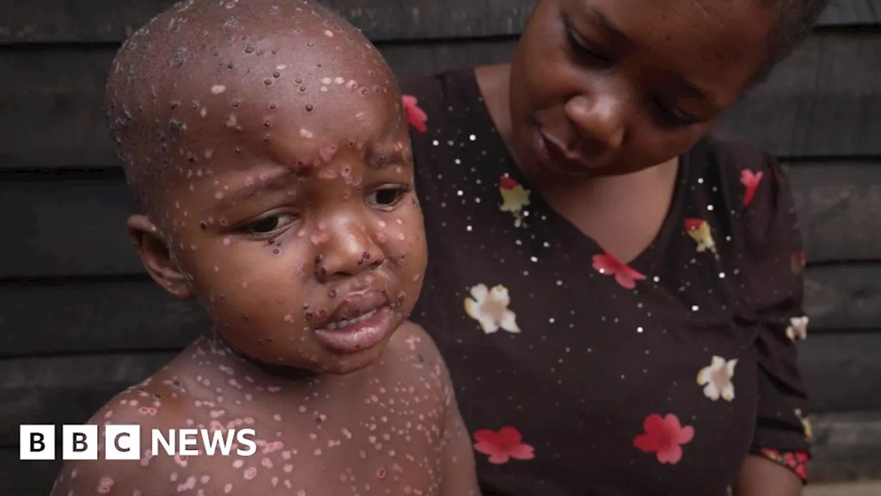 Mpox in DR Congo: The children who are suffering the most