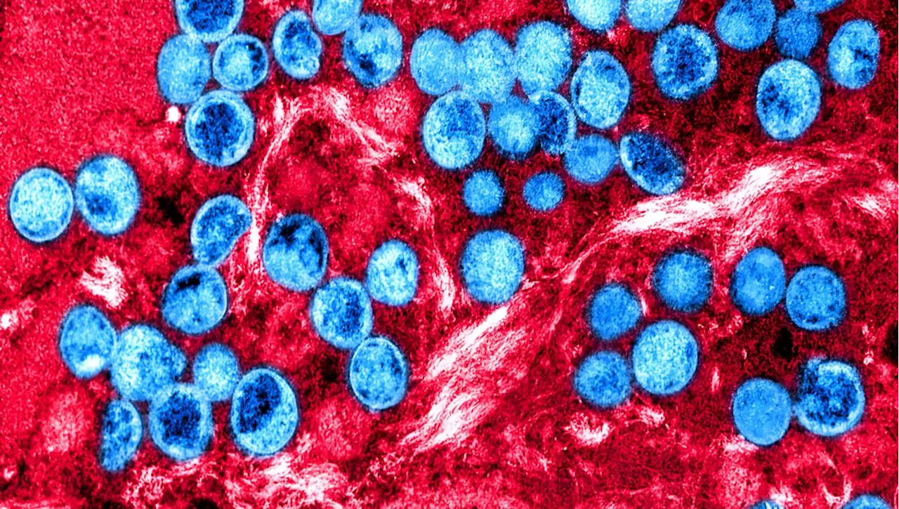 Mpox : radiographie d’un virus