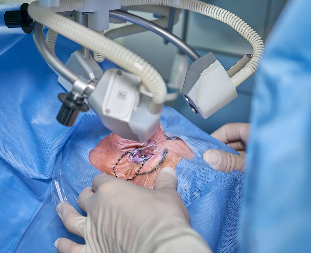 People of lower socioeconomic status less likely to receive cataract surgery in private clinics, research shows