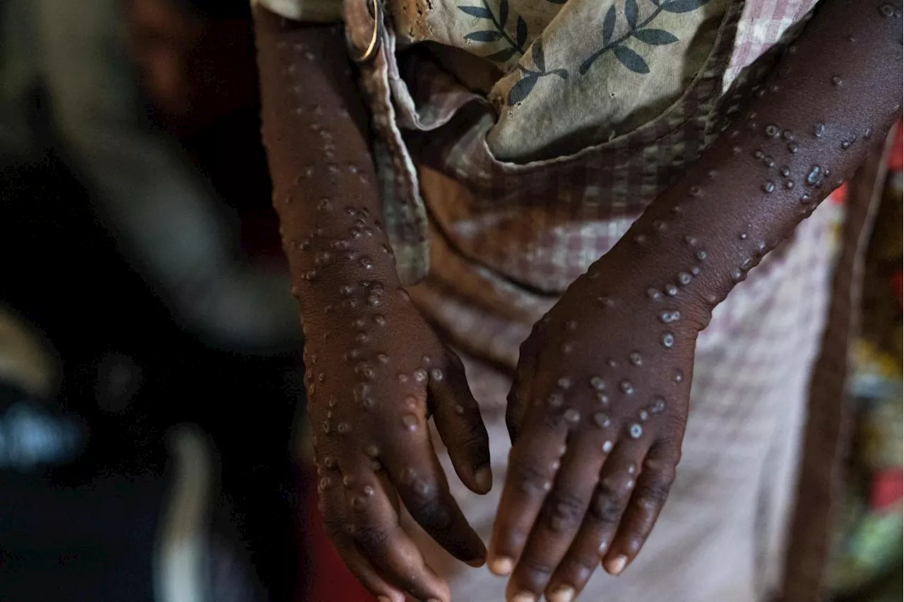 Mpox: 25 cases confirmed negative from 31 suspected cases