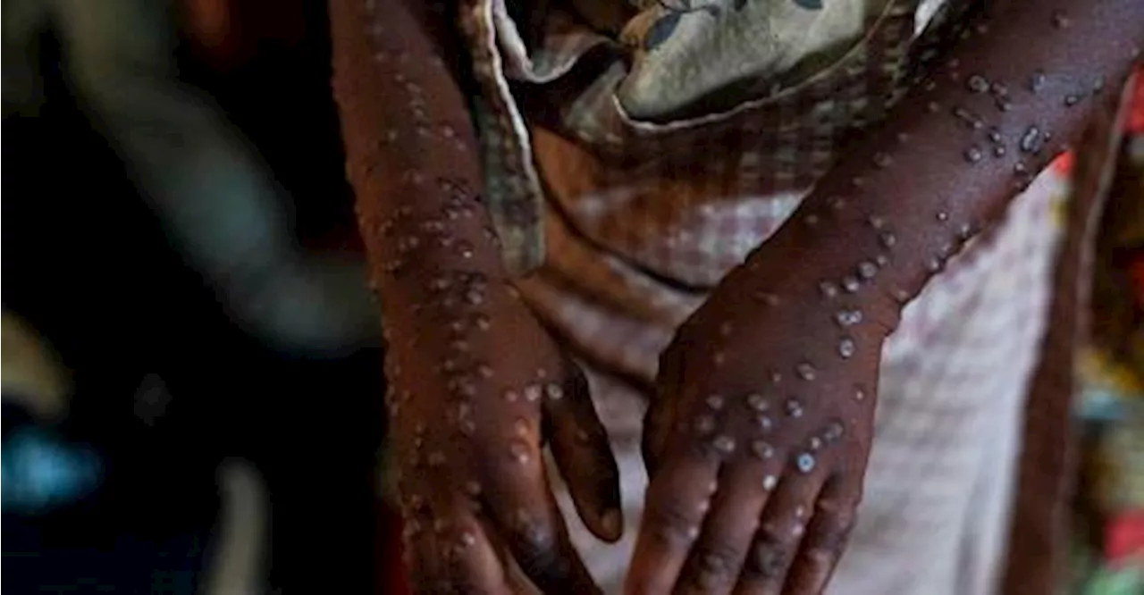 Mpox: 25 cases confirmed negative from 31 suspected cases