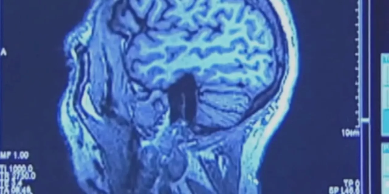 Medical professionals weigh in on football-related brain injuries