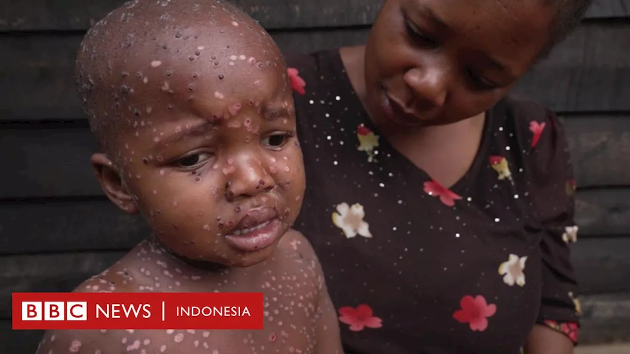 Mpox: Kisah anak-anak yang terdampak paling parah di pusat wabah cacar monyet di Kongo