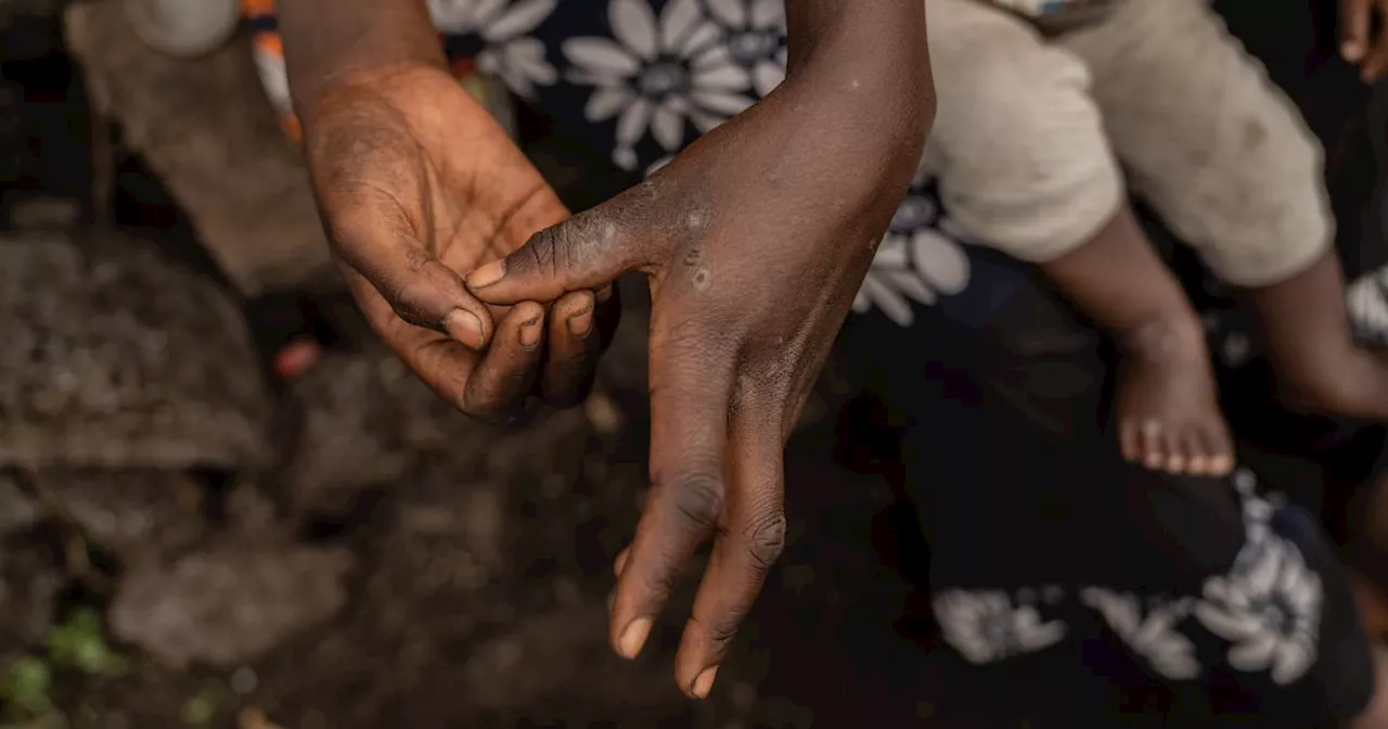 United Nations agencies concerned by mpox spread in Congo’s refugee camps