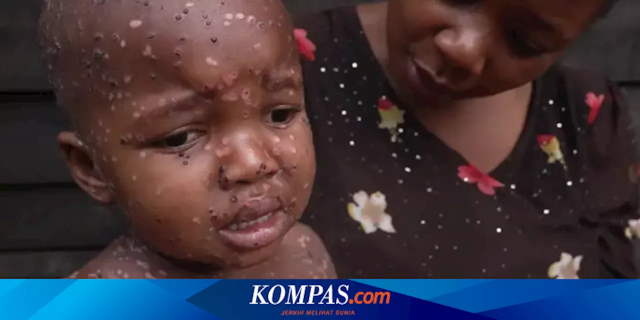 Begini Kondisi Anak-anak di RD Kongo yang Terdampak Mpox, Dokter: Jangan Anggap Remeh