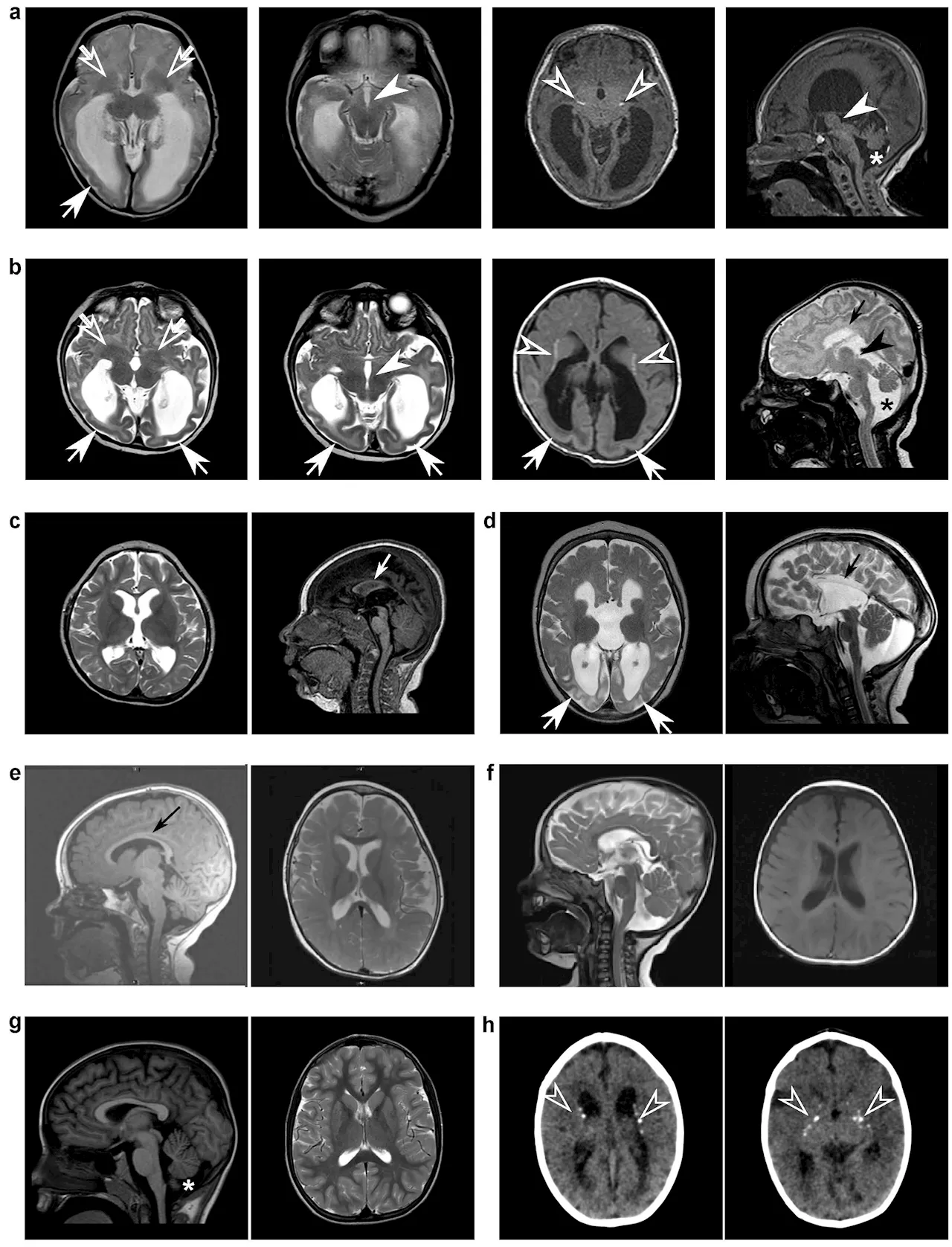 Discovery gives answers to parents of children with rare neurological gene mutation