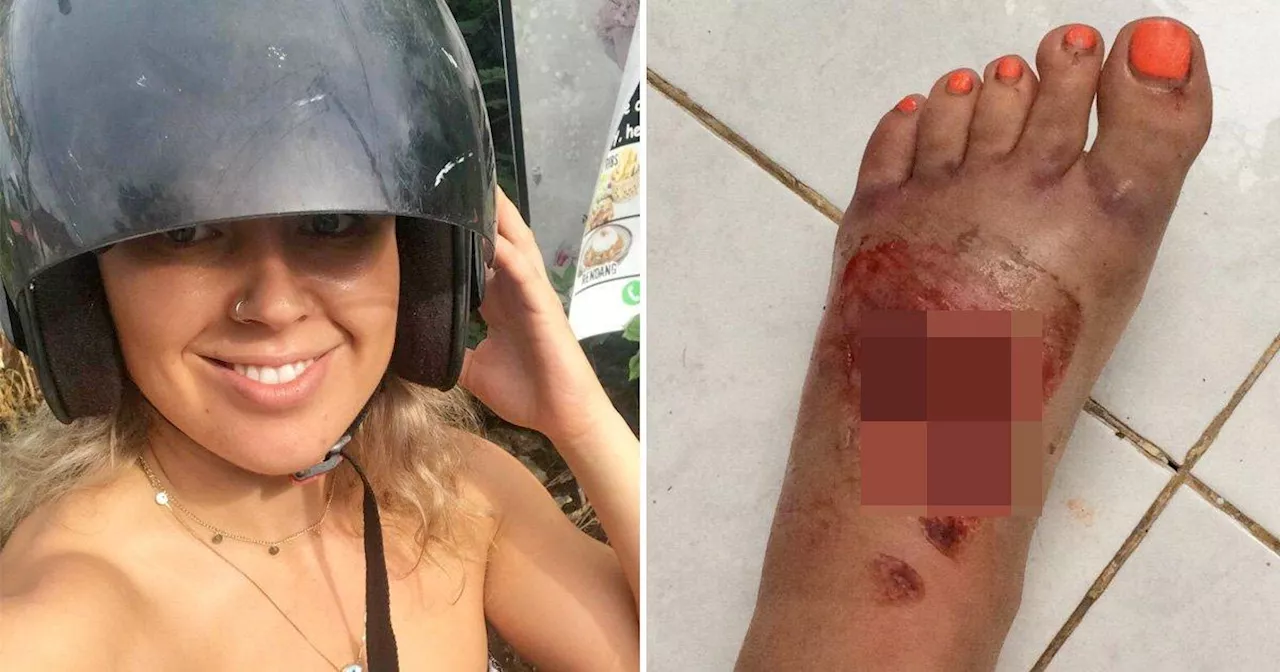 British tourist almost loses foot after being impaled in moped crash