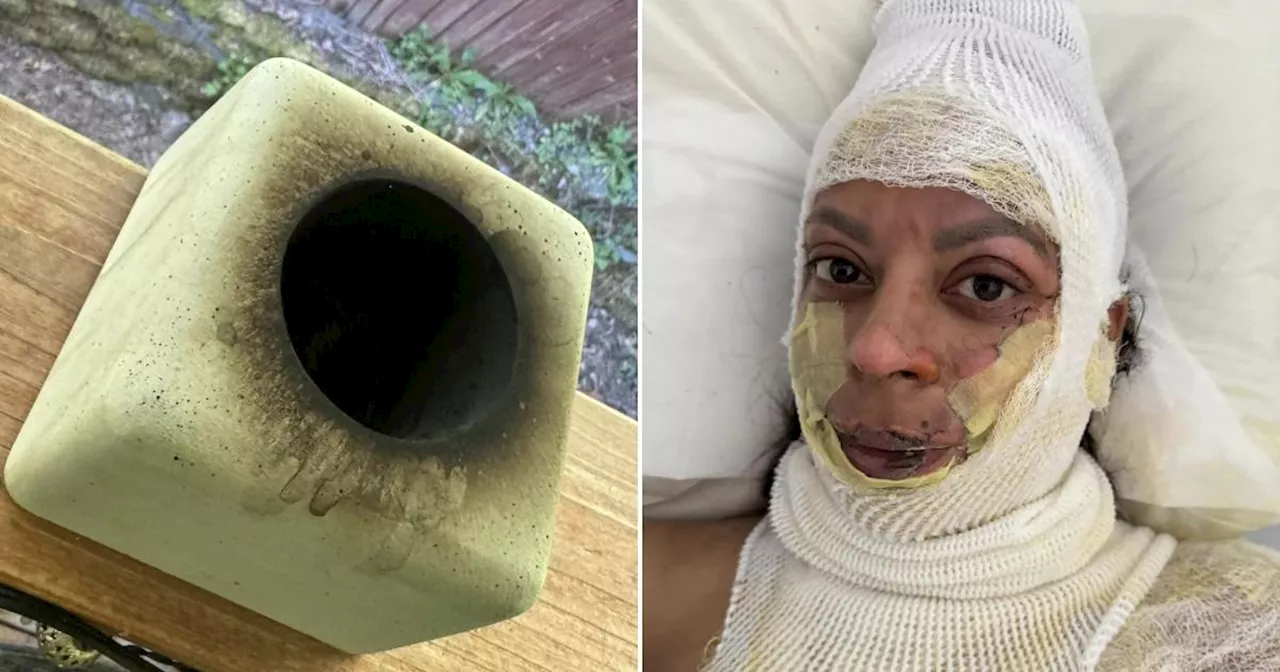 Mum's face peeled off after portable fireplace 'lit her up like a firework'