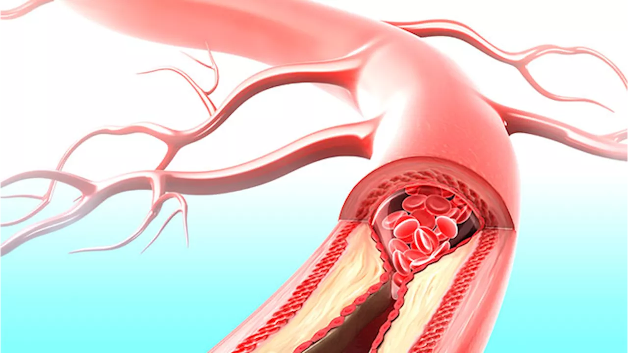 Colesterolo alto: ecco la terapia che lo riduce con sole due somministrazioni l’anno