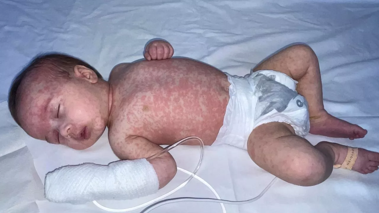 Mum urges parents to vaccinate children after baby left 'struggling to breath' with measles