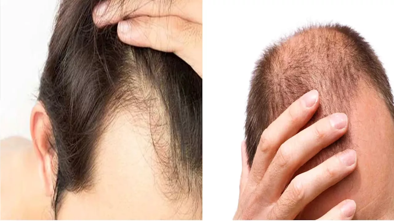 Hair care Tips: ಪುರುಷರ ಬೊಕ್ಕ ತಲೆಗೆ ಕಾರಣವೇನು? ಇಲ್ಲಿದೆ ಸರಳ ಉತ್ತರ