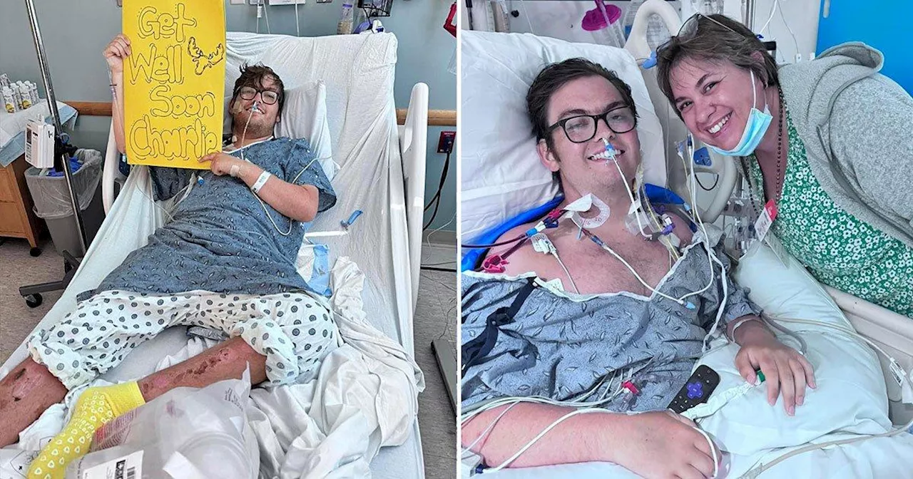 Student 'died for 25 minutes' after suffering extreme sunburn