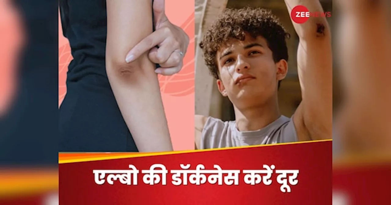 Dark Elbows: कोहनी का कालापन छिपाने के लिए पहनने लगे हैं फुल स्लीव कपड़े? ऐसे दूर होगी डार्कनेस