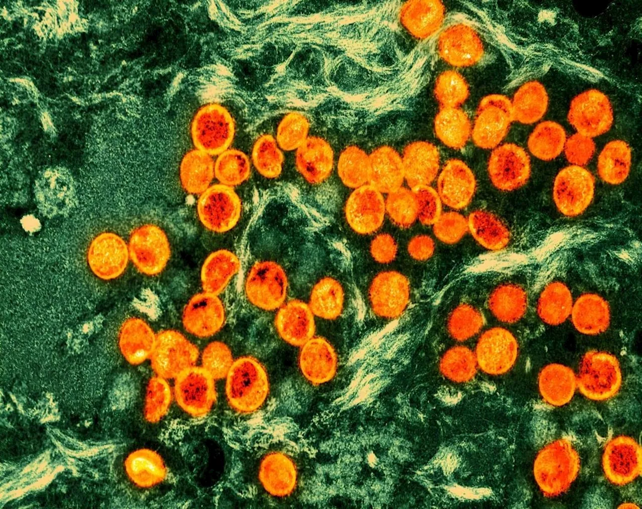 Pakistan reports first case of deadly mpox virus