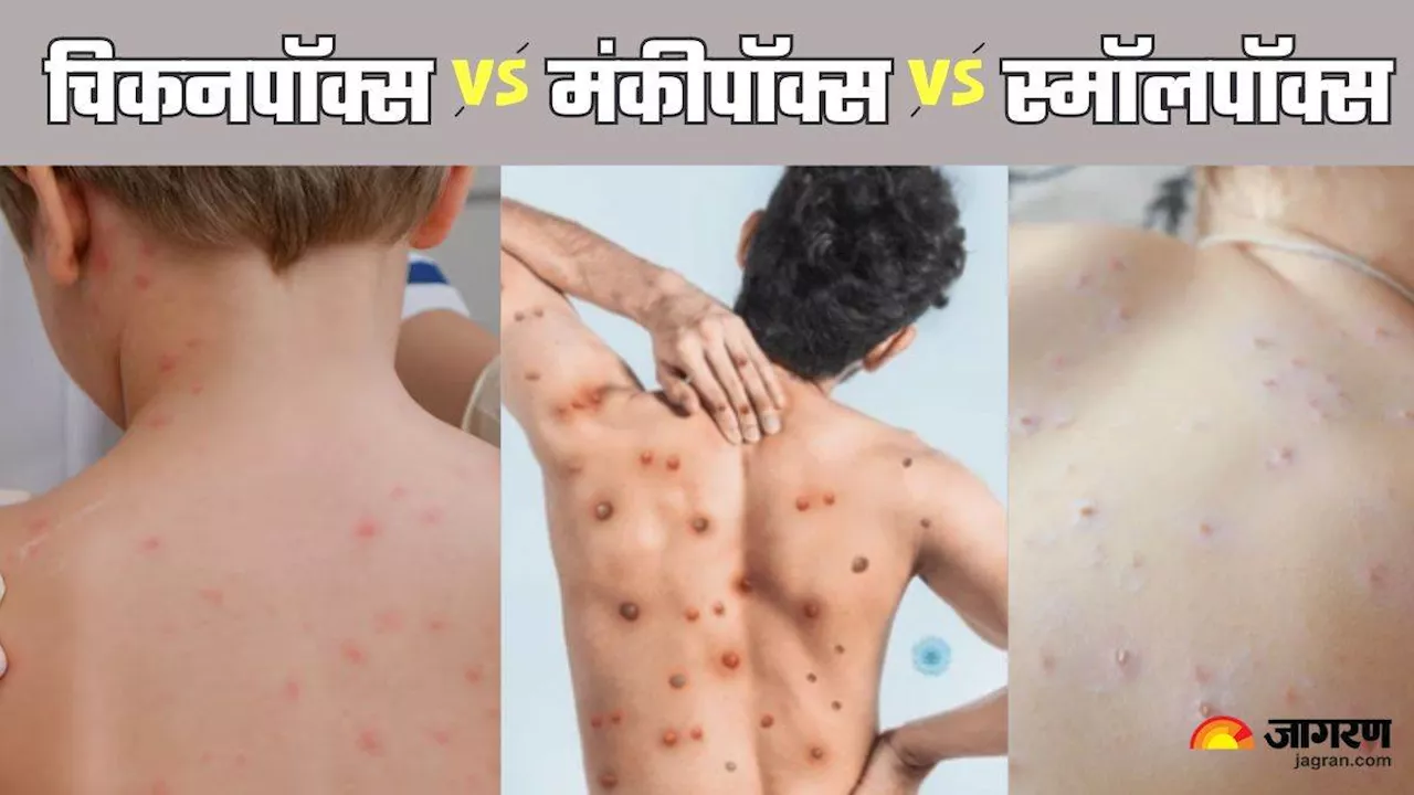 एक-दूसरे से कितने अलग हैं Chickenpox, Smallpox और Mpox, डॉक्टर ने बताया तीनों के बीच का अंतर