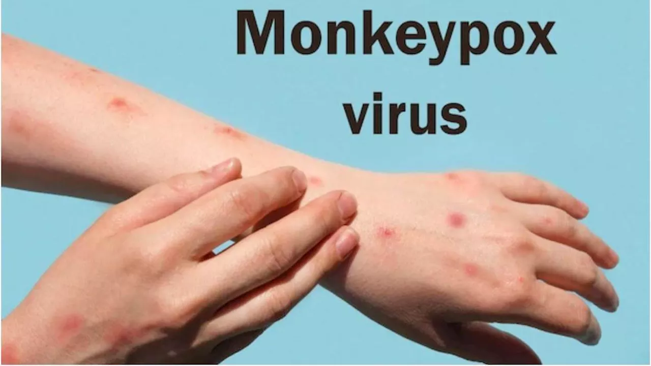 Monkeypox: बिहार में मंकी पॉक्स को लेकर अलर्ट, 3 एयरपोर्ट पर होगी स्क्रीनिंग, पढ़ें कैसे फैलती है यह बीमारी?