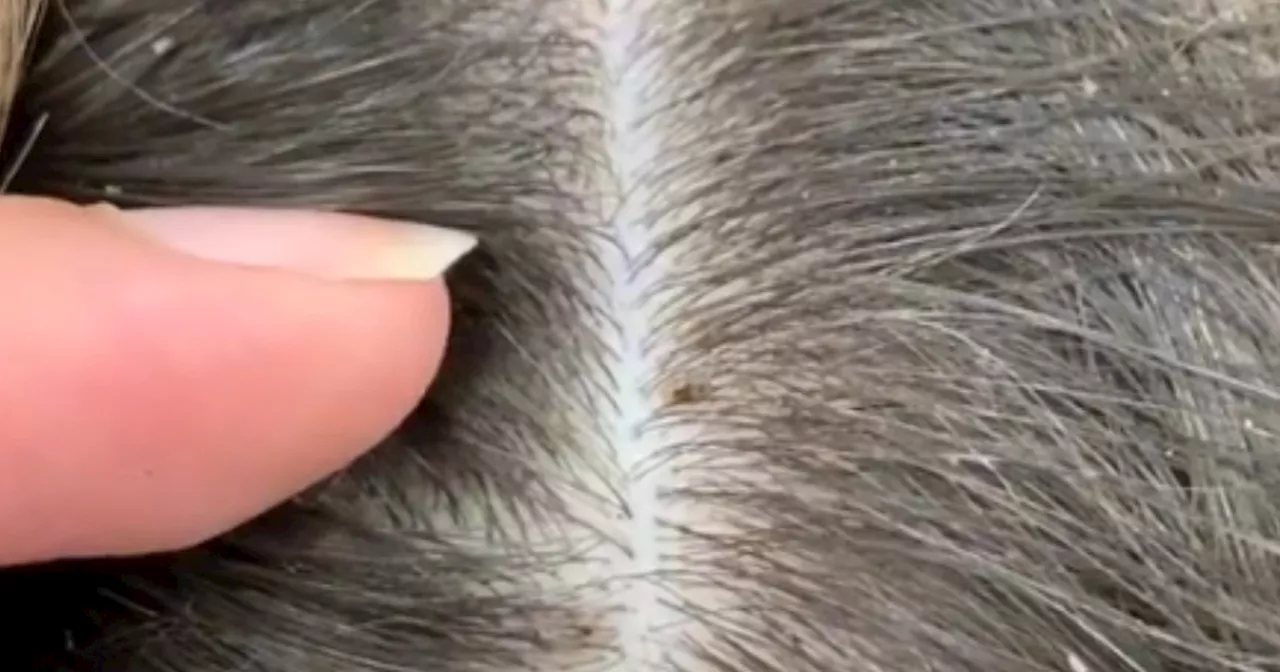 Frisør deler video, der får hovedbunden til at klø: Vent til du ser, hvad hun finder