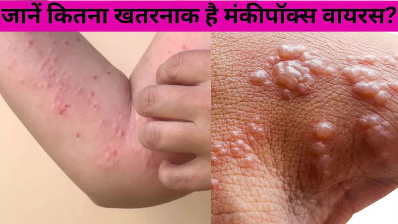 Monkeypox Virus: कितना खतरनाक है मंकीपॉक्स वायरस, जानें लक्षण और बचाव के उपाय!