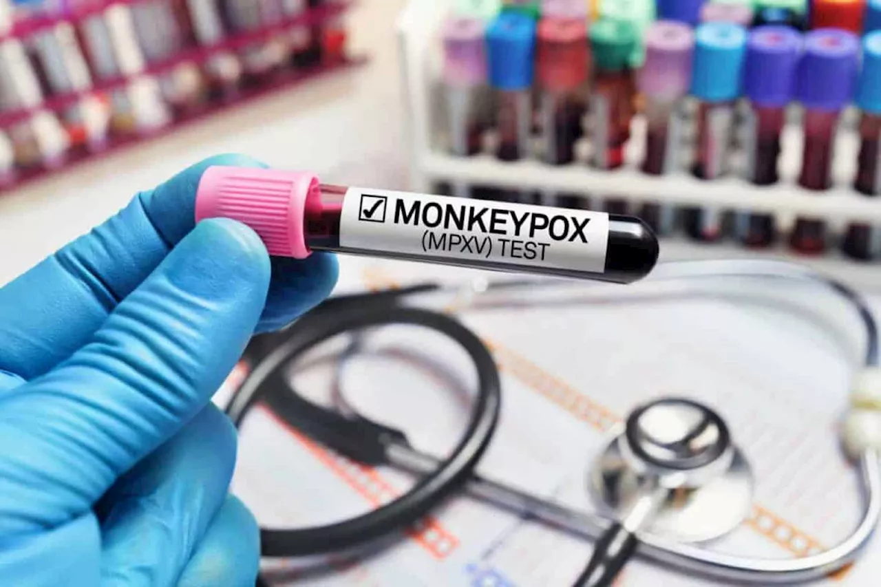 Monkeypox update: Man with travel history to Peru, one of two new cases