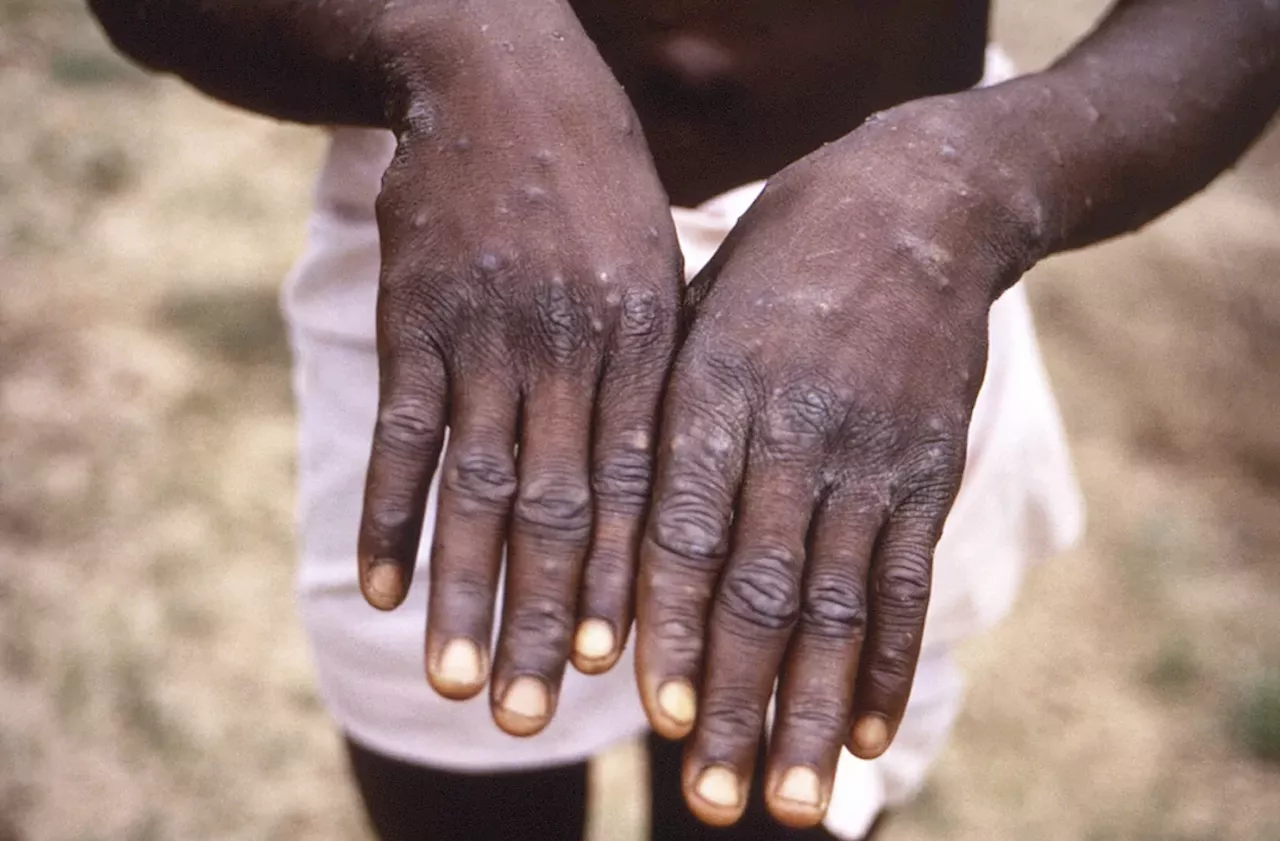 WHO considers declaring international health emergency over deadlier strain of mpox