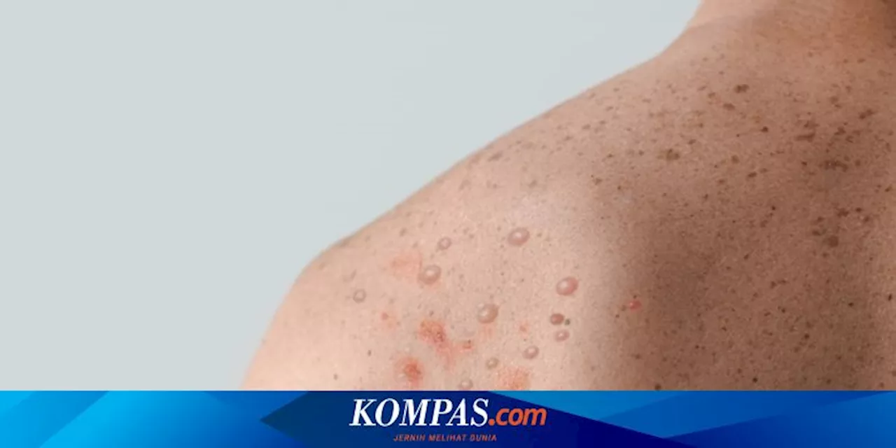 WHO Pertimbangkan Bentuk Komite untuk Tetapkan Status Mpox Jadi Darurat Internasional