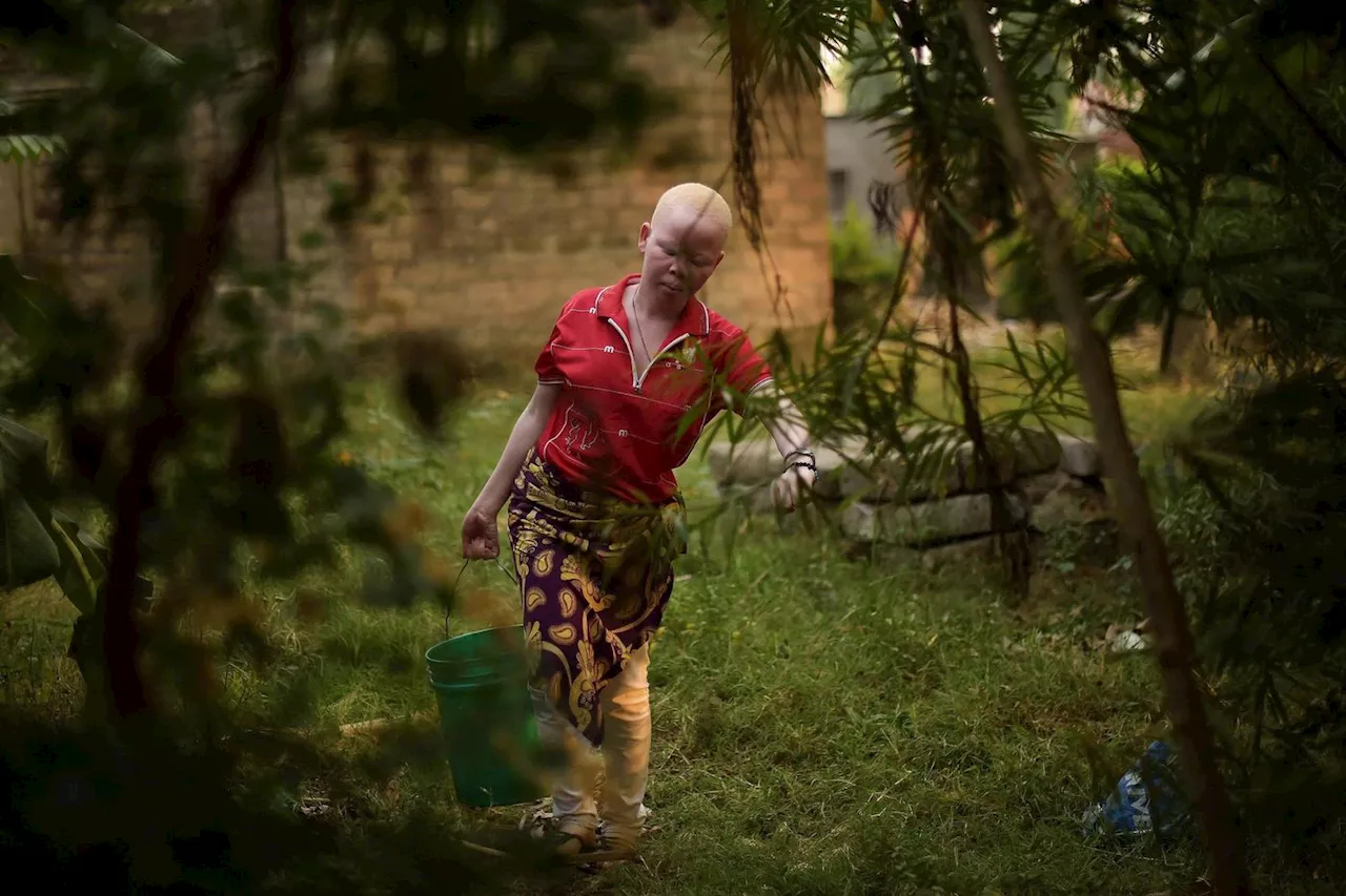 En Tanzanie, les albinos déchaînent les violences et les convoitises