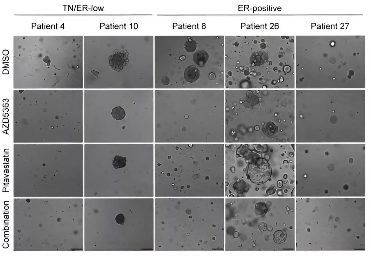 Combining cholesterol-lowering statins with existing cancer drug shows potent effect against breast cancer subtype