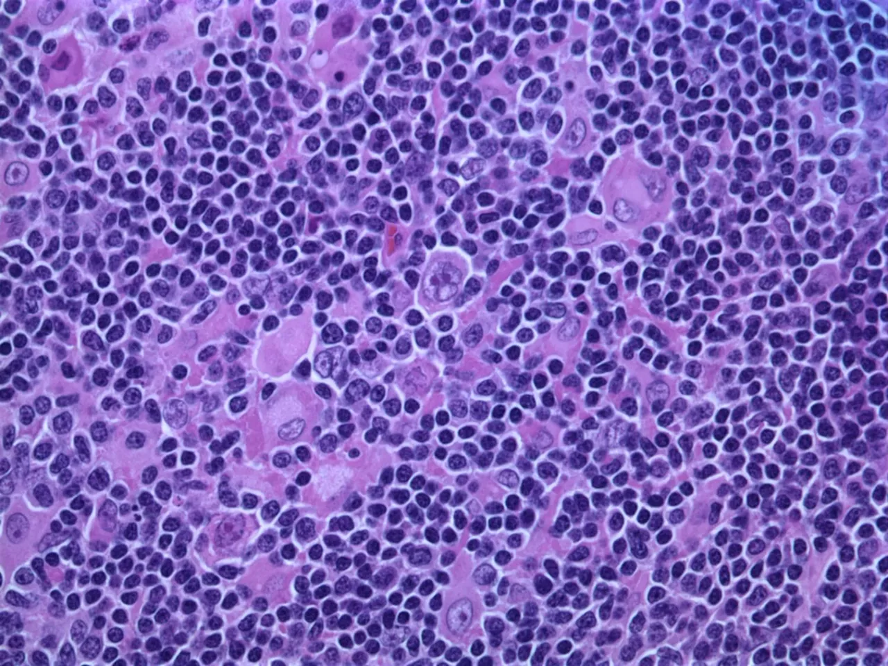 Study answers questions about long-term survivorship following CAR T treatment