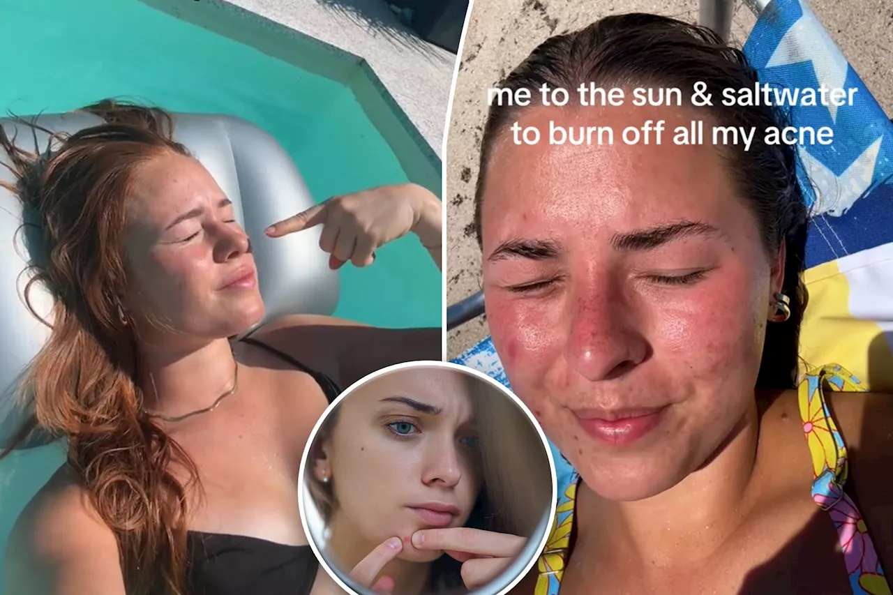 Acne sufferers swear by 'insane' cure — the 'sunburning' trend: 'Sorry mom, it's the only way'