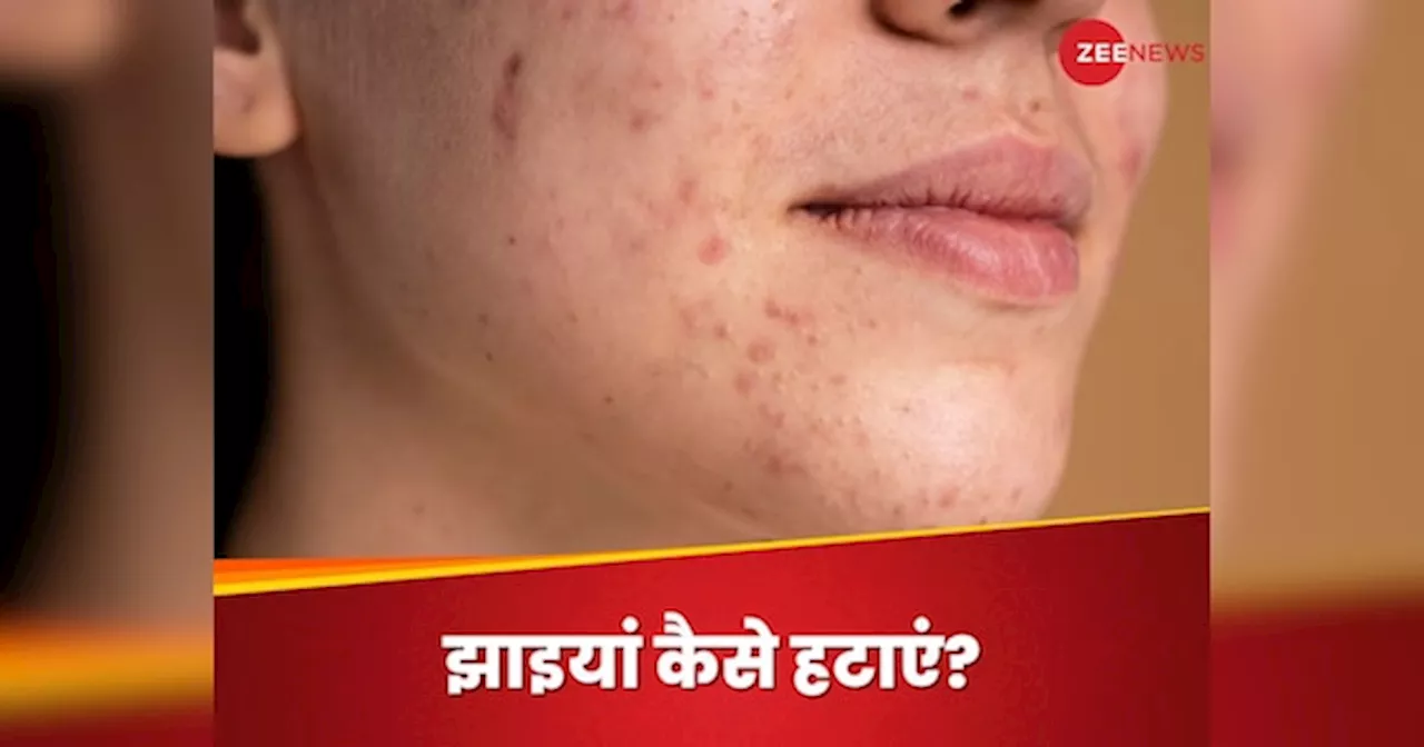 Pigmentation: झाइयों ने बिगाड़ दी है शक्ल? ग्लो वापस लाने में मदद करेगा ये हेल्दी ऑयल