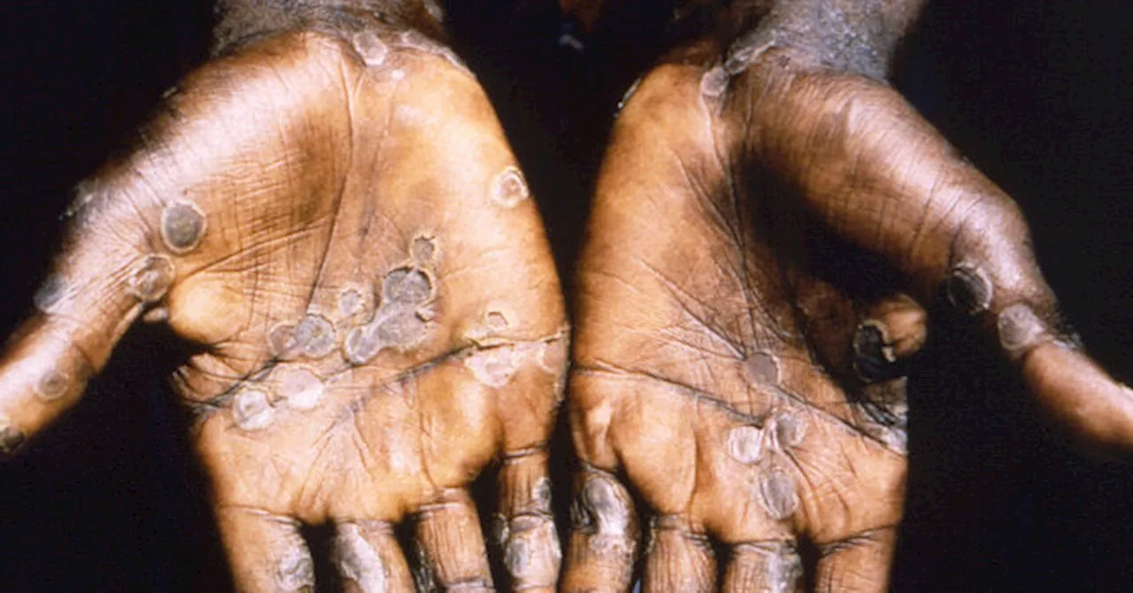 World Health Organization Considers Declaring International Monkeypox Emergency